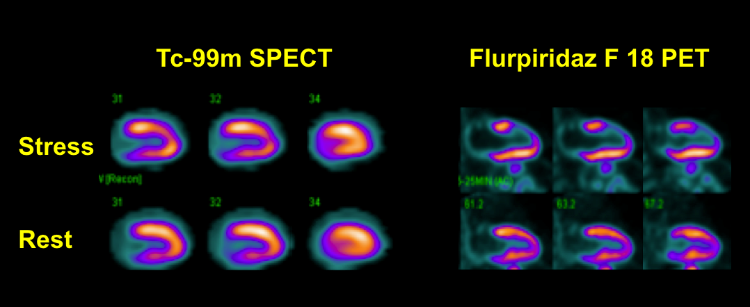Flurpiridaz F-18 May Expand PET for Myocardial Perfusion Imaging